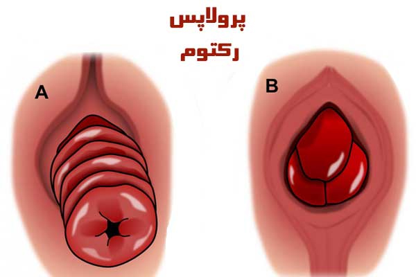 بیرون زدگی مقعدی چیست و چگونه آن را درمان کنیم؟