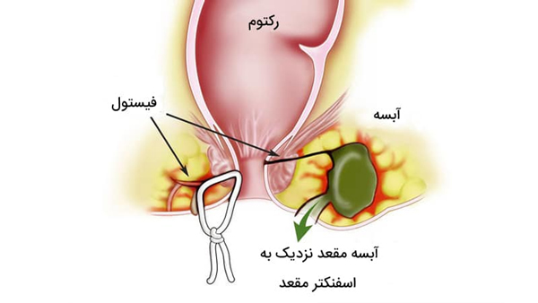 ورزش های سنگین چه تاثیری در ایجاد فیستول مقعدی دارند؟